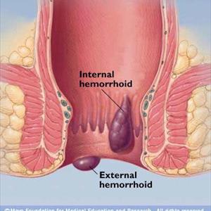 Doctors For Hemroid Surgery - Natural Hemorrhoid Treatment - How To Get Rid Of Severe Itching, Bleeding And Pain For Good