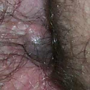 External Hemorrhoid Picture - Shrink Hemorrhoids - Cure Hemorrhoids At Home - Hemorrhoid Cream