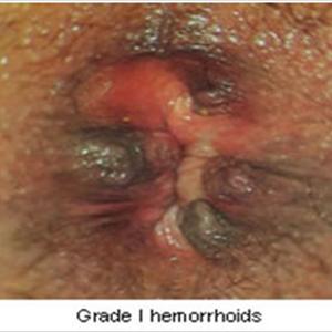 Laser Surgery For Hemroids - Common Hemorrhoid Symptoms