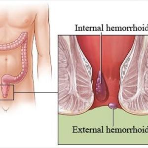 Types Of Hemorrhoids - Hemmorhoids Treatment - Hemroids Wiki - Dog Hemorrhoids