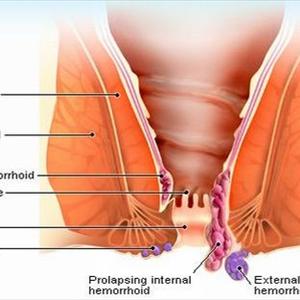 Bleeding From Hemorrhoids - Cure Hemorrhoid At Home - Treating Hemorrhoids With Onion, Purslane, Honey And White Radish