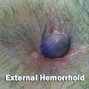 Hemroid Creams - Things You Must Know About Hemorrhoid Treatment