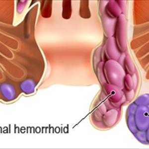 Type Doctor Treats Hemorrhoids - Why Simple Hemorrhoid Treatment Is More Effective And Preferable