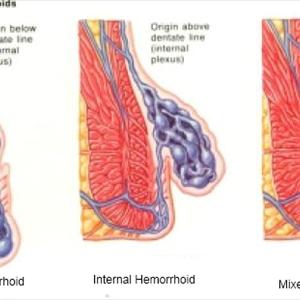 Types Of Hemroids - Hemorrhoid Treatment - Just Make The Itching And Burning Go Away!