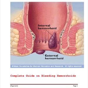 Hemroid Facts - Hemorrhoids Treatments At Home