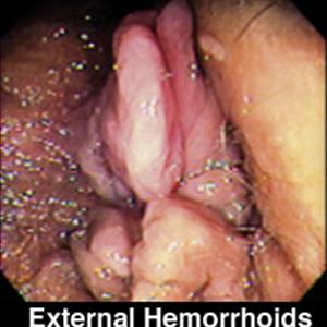 Hemorrhoids Operation - Hemorrhoids Treatments - Home And Surgery